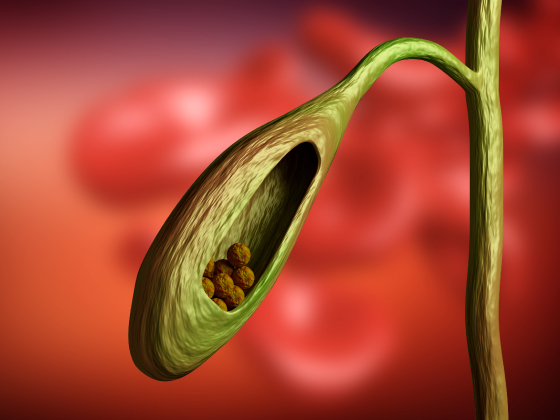 best-gall-stones-complex-gallbladder-surgery-meerpet