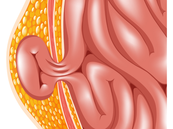 best-hernia-treatment-meerpet