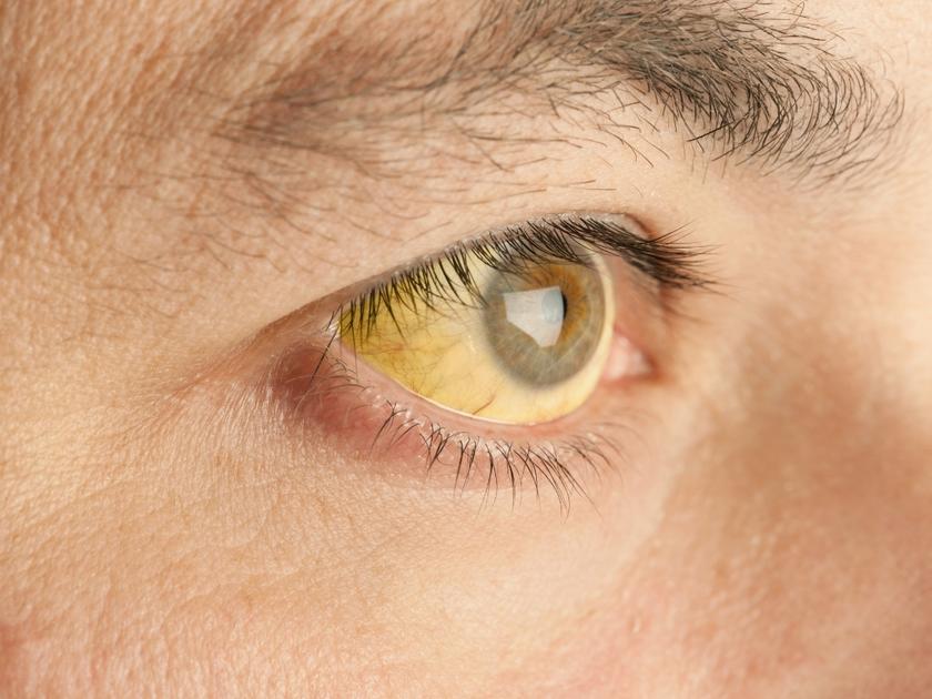 best-jaundice-treatment-meerpet