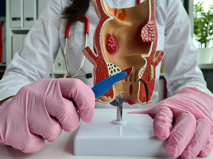 best-laser-treatment-piles-fistula-treatment-meerpet